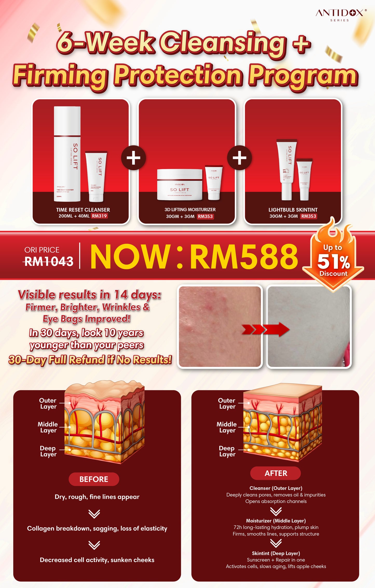 OCT SOLIFT 6-Week Treatment Package